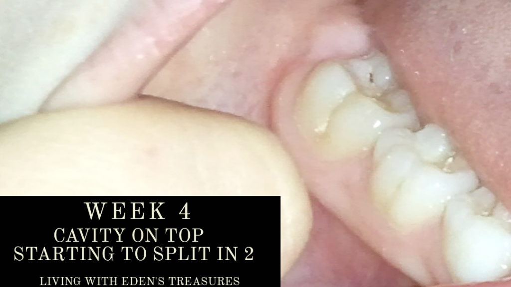 Week 4 cavity in tooth splitting