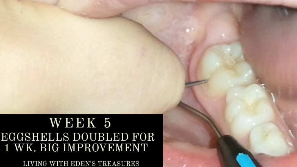 Week 5 cavity improving greatly after 1 week of 2 eggshells a day. 