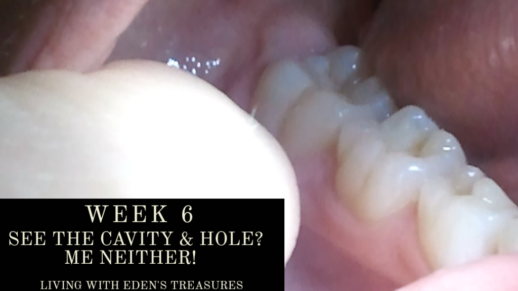 Week 6... where did that cavity go?